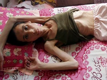 Kein Nazikonzentrationslager, sondern ein heutiges chinesisches Arbeitslager: Frau Ren Shujie (42) wog nur noch 40 kg nach Folter und unmenschlicher Behandlung in einem chinesischen Arbeitslager