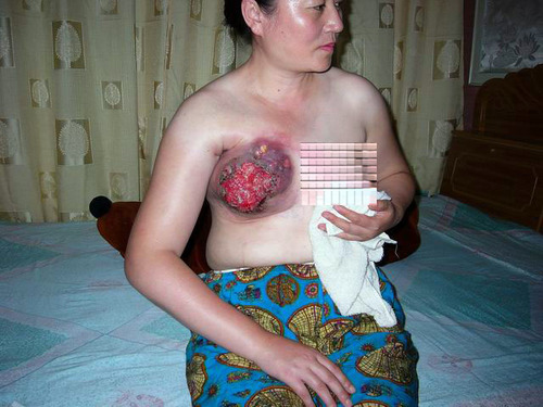 Brutale Verstümmelung der Brust von Frau Wang Yunjie durch Beamte des Benxi Camp, Provinz Liaoning