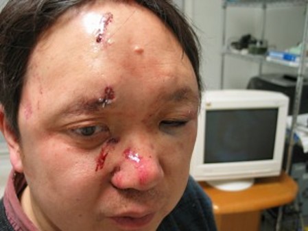 Dr. Peter Yuan Li trug bei dem Überfall erhebliche Wunden im Gesicht davon